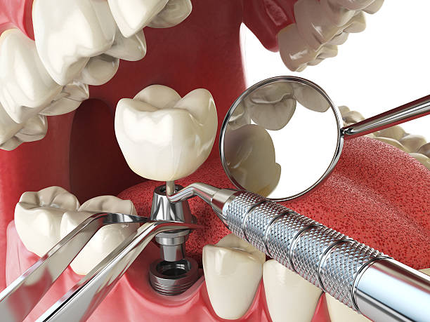 Best Emergency Dentist for Lost Fillings or Crowns in Concord, VA